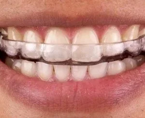 Clear custom night guard worn over the teeth
